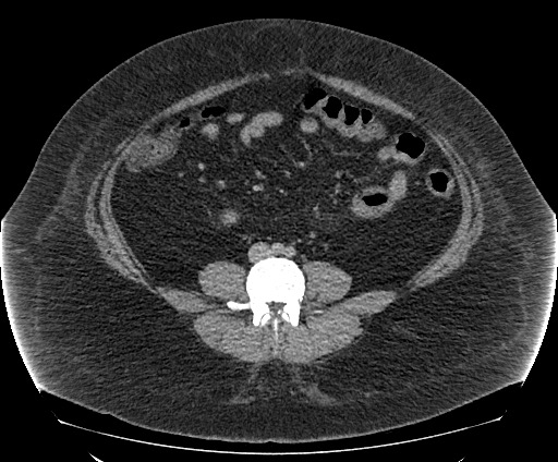 Bowel and splenic infarcts in acute lymphocytic leukemia (Radiopaedia 61055-68913 A 79).jpg