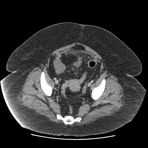 Bowel and splenic infarcts in acute lymphocytic leukemia (Radiopaedia 61055-68915 A 111).jpg
