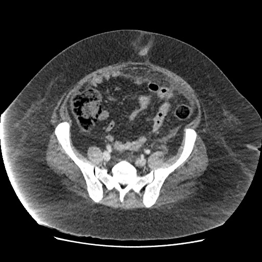 File:Bowel and splenic infarcts in acute lymphocytic leukemia (Radiopaedia 61055-68915 A 99).jpg