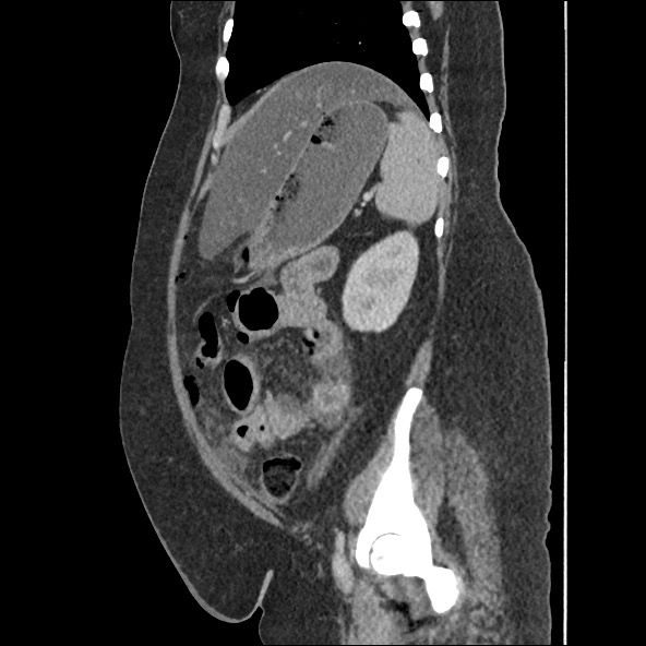 Bowel and splenic infarcts in acute lymphocytic leukemia (Radiopaedia 61055-68915 C 21).jpg