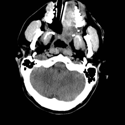 File:Brain death after motor vehicle collision (Radiopaedia 88470-105114 Axial 21).png