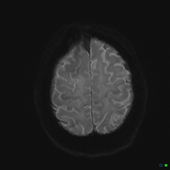 File:Brain death on MRI and CT angiography (Radiopaedia 42560-45689 Axial DWI 22).jpg