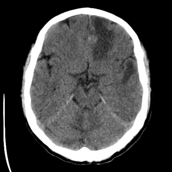 Brain metastases from lung cancer (Radiopaedia 24480-24781 Axial non-contrast 16).jpg