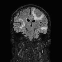 File:Brain metastases from lung cancer (Radiopaedia 83839-99028 Coronal FLAIR 45).jpg