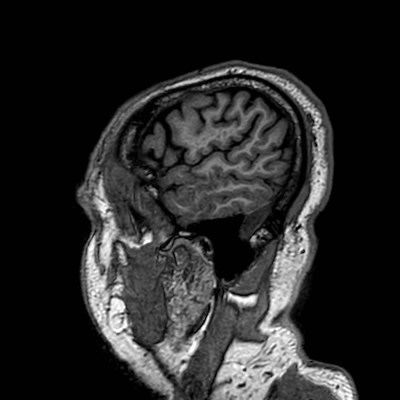 Brain metastases from lung cancer (Radiopaedia 83839-99028 Sagittal T1 116).jpg