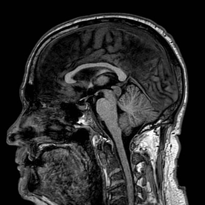 Brain metastases from lung cancer (Radiopaedia 83839-99028 Sagittal T1 65).jpg