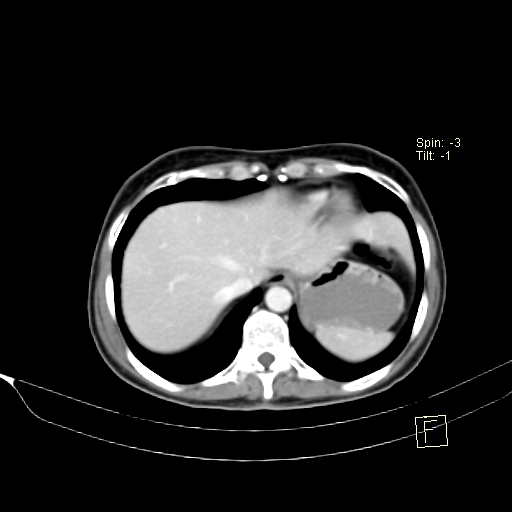 Brain metastasis as initial presentation of non-small cell lung cancer (Radiopaedia 65122-74127 A 40).jpg