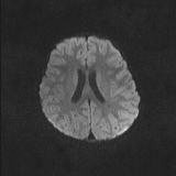 Brainstem glioma (Radiopaedia 67531-76922 Axial DWI 62).jpg