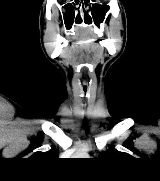 Branchial cleft cyst (Radiopaedia 31167-31875 Coronal C+ delayed 23).jpg