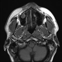 File:Branchial cleft cyst (Radiopaedia 31167-31876 Axial T1 25).jpg