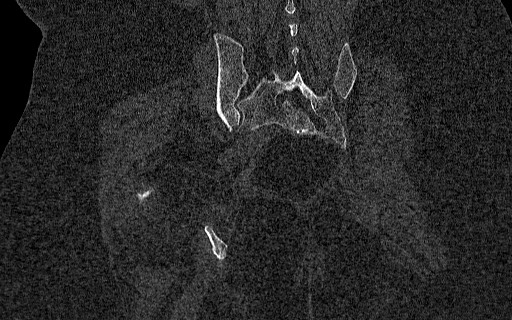 Breast carcinoma with pathological hip fracture (Radiopaedia 60314-67993 Coronal bone window 88).jpg