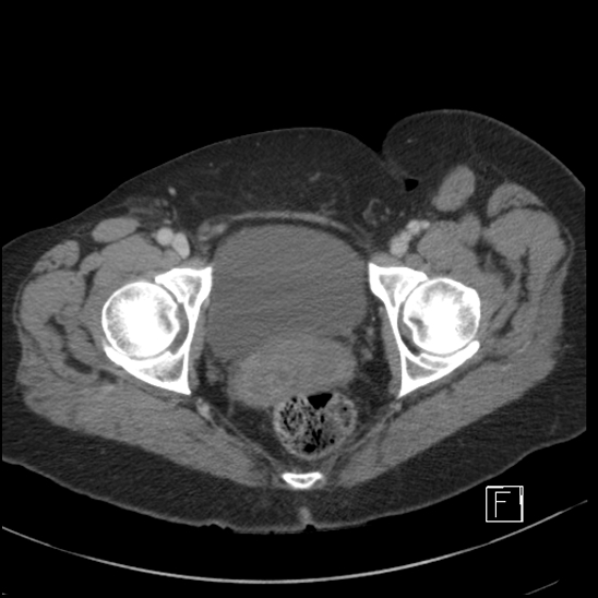 File:Breast metastases from renal cell cancer (Radiopaedia 79220-92225 C 114).jpg
