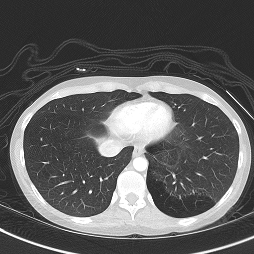 File:Bronchial atresia (Radiopaedia 73677-84470 Axial lung window 46).jpg
