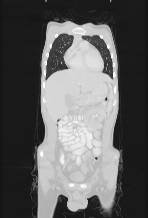 Bronchial carcinoid tumor (Radiopaedia 57187-64090 Coronal lung window 20).jpg