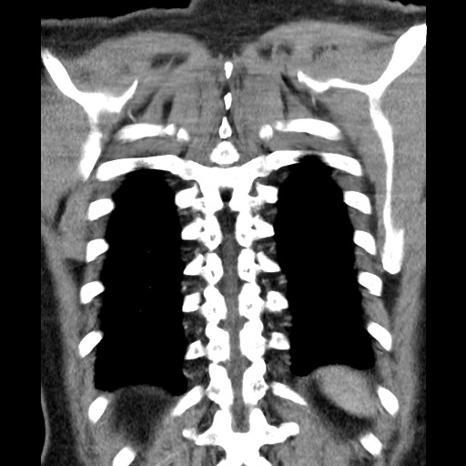 File:Bronchial carcinoid tumor (Radiopaedia 67377-76764 C 54).jpg