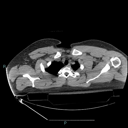 Bronchial carcinoid tumor (Radiopaedia 78272-90870 Axial non-contrast 13).jpg