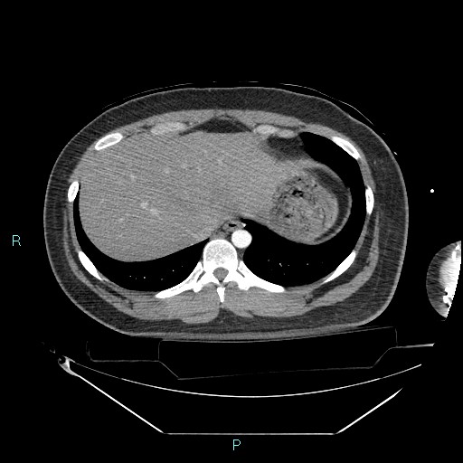 Bronchial carcinoid tumor (Radiopaedia 78272-90870 B 101).jpg