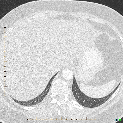 File:Bronchial diverticula (Radiopaedia 79512-92676 Axial lung window 188).jpg