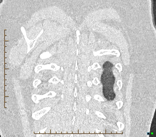 Bronchial diverticula (Radiopaedia 79512-92676 B 178).jpg