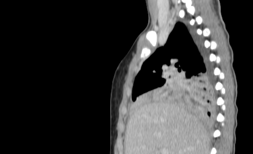 Bronchial mucoepidermoid carcinoma (Radiopaedia 57023-63895 Sagittal 72).jpg