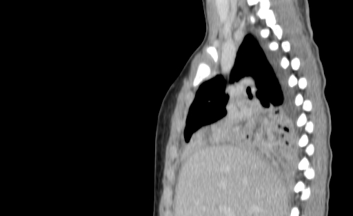 Bronchial mucoepidermoid carcinoma (Radiopaedia 57023-63895 Sagittal 79).jpg