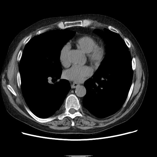 Bronchial stenosis - lung transplant (Radiopaedia 73133-83848 Axial non-contrast 37).jpg