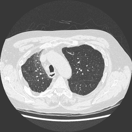 File:Bronchial stenosis - lung transplant (Radiopaedia 73133-83848 C 4).jpg