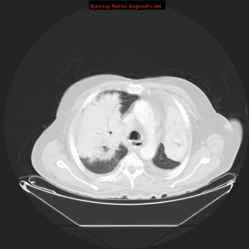 File:Bronchioloalveolar carcinoma (Radiopaedia 9272-9955 Axial lung window 10).jpg