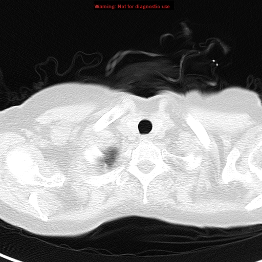 File:Bronchoalveolar carcinoma (BAC) (Radiopaedia 13436-13392 Axial lung window 2).jpg
