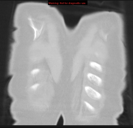 Bronchoalveolar carcinoma (BAC) (Radiopaedia 13436-13392 Coronal lung window 59).jpg