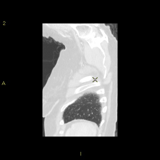 File:Bronchogenic carcinoma as an incidental finding (Radiopaedia 16453-16130 Sagittal lung window 7).jpg