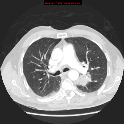 File:Bronchogenic carcinoma brain metastasis (Radiopaedia 9286-105832 Axial lung window 7).jpg