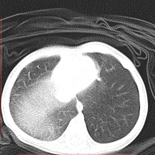 Bronchogenic cyst (Radiopaedia 78599-91409 Axial lung window 118).jpg