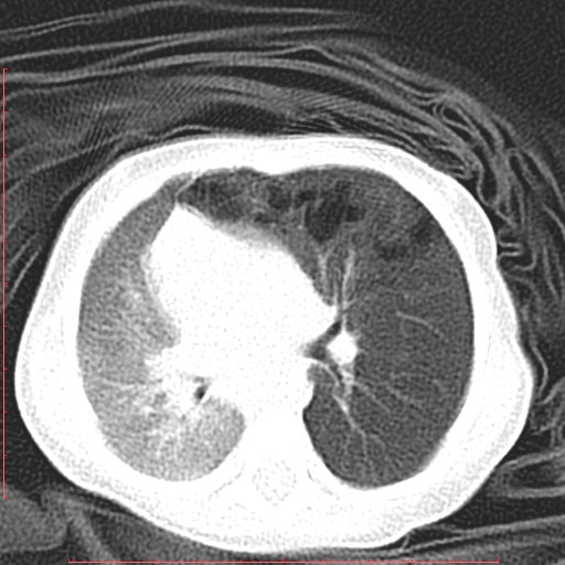 Bronchogenic cyst (Radiopaedia 78599-91409 Axial lung window 69).jpg