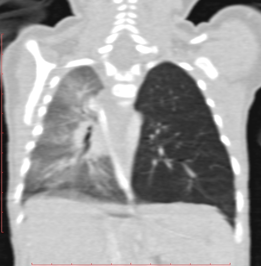Bronchogenic cyst (Radiopaedia 78599-91409 Coronal lung window 148).jpg