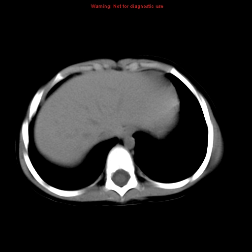 File:Bronchogenic cyst (Radiopaedia 9372-10063 Axial non-contrast 15).jpg