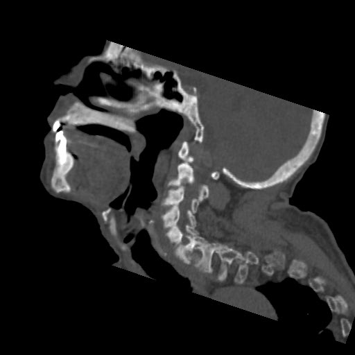 File:Brown tumor with secondary hyperparathyroidism (Radiopaedia 23591-23705 B 6).jpg