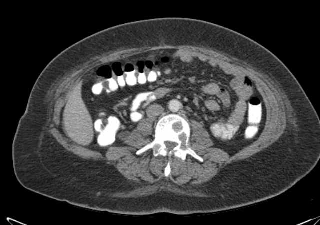 File:Brown tumors compressing the spinal cord (Radiopaedia 68442-77988 E 64).jpg