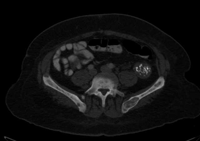 Brown tumors compressing the spinal cord (Radiopaedia 68442-77988 G 85).jpg