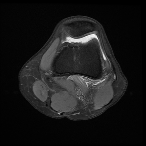 File:Bucket-handle meniscus tear (Radiopaedia 65700-74809 Axial PD fat sat 9).jpg