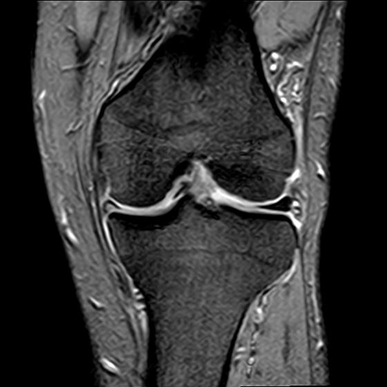 File:Bucket handle tear - medial meniscus (Radiopaedia 29250-29664 B 10).jpg