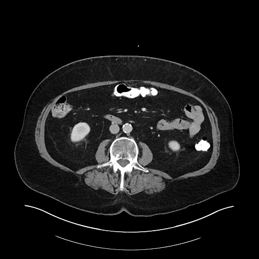 Buried bumper syndrome - gastrostomy tube (Radiopaedia 63843-72575 A 45).jpg