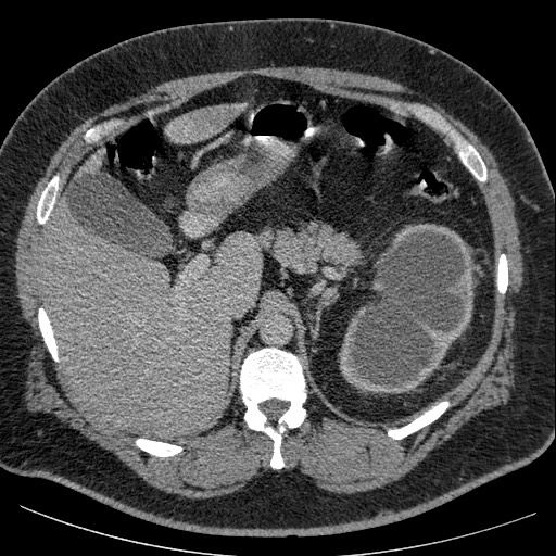 File:Burned-out testicular seminoma - retroperitoneal nodal metastases (Radiopaedia 62872-71245 A 19).jpg