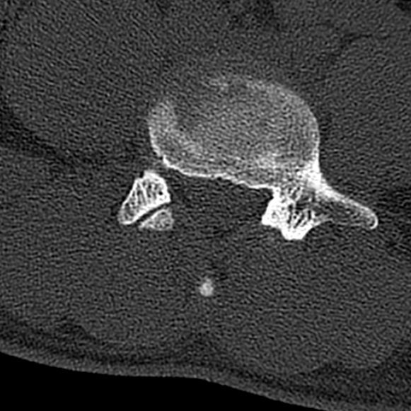 Burst fracture (Radiopaedia 53373-59357 Axial bone window 55).jpg