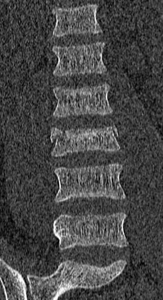 Burst fracture (Radiopaedia 53373-59357 Coronal bone window 24).jpg
