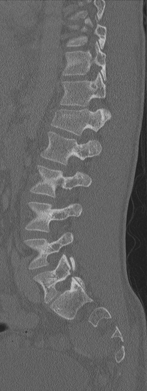Burst fracture - T12 with conus compression (Radiopaedia 56825-63647 Sagittal bone window 30).png