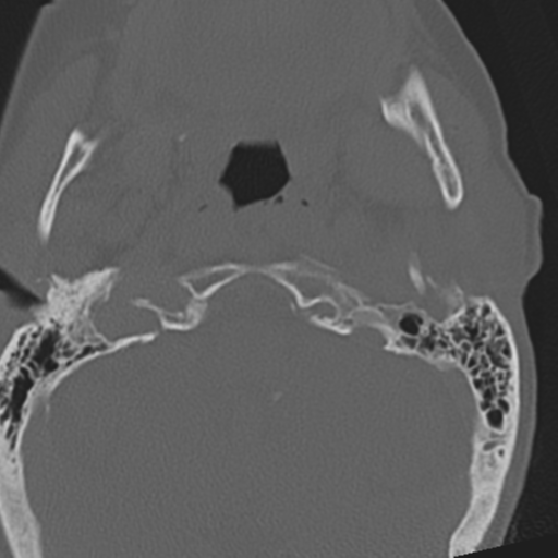 C2 fracture with vertebral artery dissection (Radiopaedia 37378-39199 Axial bone window 7).png