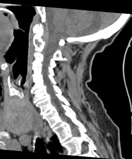 C2 fracture with vertebral artery dissection (Radiopaedia 37378-39199 D 45).png