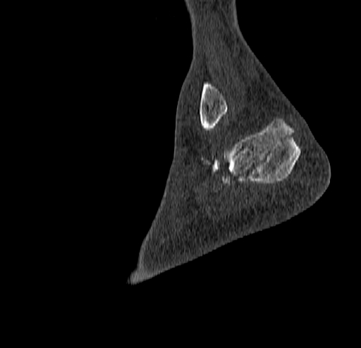 File:Calcaneal fracture - Sanders type 4 (Radiopaedia 90179-107370 Sagittal bone window 73).jpg