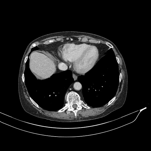 Calcified adrenal glands and Spigelian hernia (Radiopaedia 49741-54988 A 17).jpg